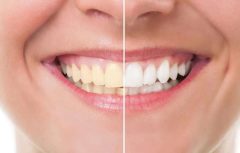 receitas-para-clarear-os-dentes